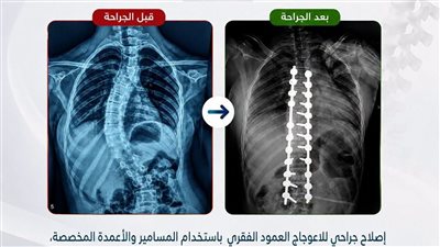 نجاح جديد في جراحات تشوهات العمود الفقري: طفلة عمرها 13 عامًا.. 