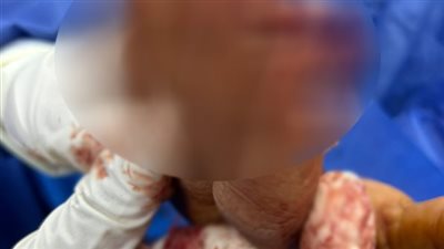 نجاح 5 تدخلات جراحية دقيقة بقسم جراحة التجميل بمستشفى السنبلاوين العام
