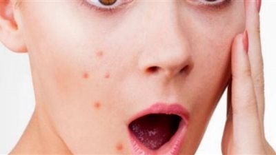 تخلصي من آثار أشعة الشمس على البشرة مع هذه الوصفة